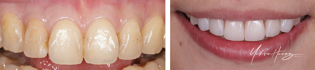 陶瓷美白貼片微笑曲線設計